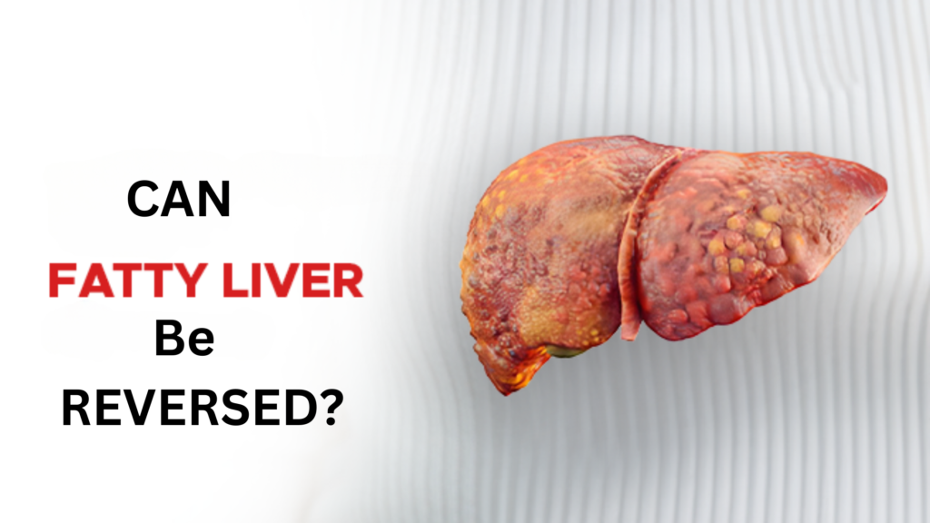 Can Fatty Liver be reversed?