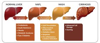 Types of Fatty Liver Disease